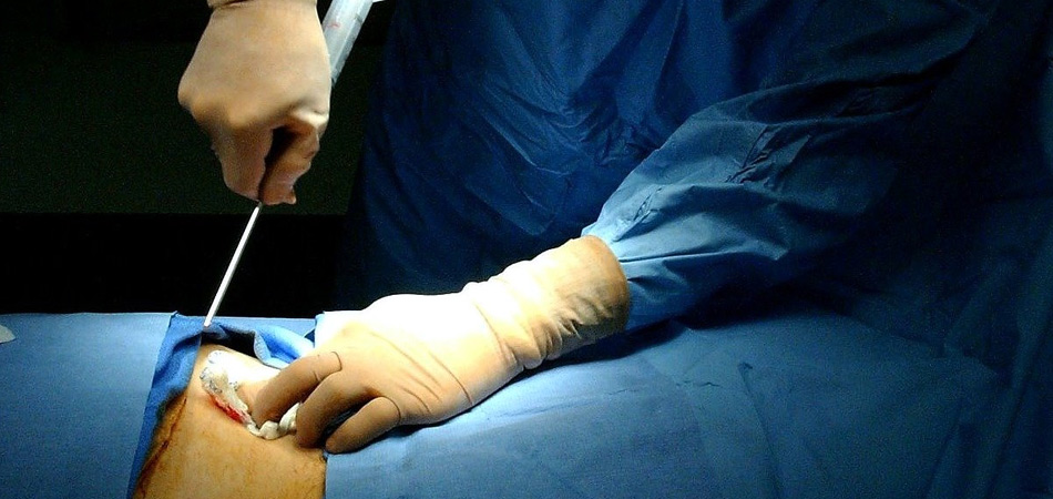 Cheap and Affordable  Bone Marrow Transplant in India, Best Hospitals for  Bone Marrow Transplant in India, Best Doctors for  Bone Marrow Transplant in India , Medkaizen Global, Apollo Hospitals, Fortis Hospitals, Max Hospitals, Artemis Hospitals, Medanta Hospitals, Manipal Hospitals, Hospitals for Medical Tourism in India, Hospital for Medical Treatment in India, Hospitals for Surgery in India, Medical Tourism in India, Medical Treatment in India, Surgery in India, Medical Tourism Company