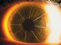 Cheap and Affordable Eye Treatment in India, Best Hospitals for Eye Treatment in India, Best Doctors for Eye Treatment in India , Medkaizen Global, Apollo Hospitals, Fortis Hospitals, Max Hospitals, Artemis Hospitals, Medanta Hospitals, Manipal Hospitals, Hospitals for Medical Tourism in India, Hospital for Medical Treatment in India, Hospitals for Surgery in India, Medical Tourism in India, Medical Treatment in India, Surgery in India, Medical Tourism Company