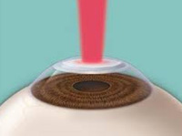 Cheap and Affordable Eye Treatment in India, Best Hospitals for Eye Treatment in India, Best Doctors for Eye Treatment in India , Medkaizen Global, Apollo Hospitals, Fortis Hospitals, Max Hospitals, Artemis Hospitals, Medanta Hospitals, Manipal Hospitals, Hospitals for Medical Tourism in India, Hospital for Medical Treatment in India, Hospitals for Surgery in India, Medical Tourism in India, Medical Treatment in India, Surgery in India, Medical Tourism Company