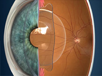 Cheap and Affordable Eye Treatment in India, Best Hospitals for Eye Treatment in India, Best Doctors for Eye Treatment in India , Medkaizen Global, Apollo Hospitals, Fortis Hospitals, Max Hospitals, Artemis Hospitals, Medanta Hospitals, Manipal Hospitals, Hospitals for Medical Tourism in India, Hospital for Medical Treatment in India, Hospitals for Surgery in India, Medical Tourism in India, Medical Treatment in India, Surgery in India, Medical Tourism Company