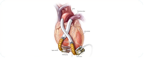 Cheap and Affordable Heart Surgery in India, Best Hospitals for Heart Surgery in India, Best Doctors for Heart Surgery in India , Medkaizen Global, Apollo Hospitals, Fortis Hospitals, Max Hospitals, Artemis Hospitals, Medanta Hospitals, Manipal Hospitals, Hospitals for Medical Tourism in India, Hospital for Medical Treatment in India, Hospitals for Surgery in India, Medical Tourism in India, Medical Treatment in India, Surgery in India, Medical Tourism Company