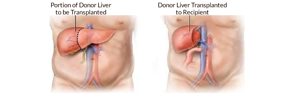 Cheap and Affordable Liver Transplant in India, Best Hospitals for Liver Transplant in India, Best Doctors for Liver Transplant in India , Medkaizen Global, Apollo Hospitals, Fortis Hospitals, Max Hospitals, Artemis Hospitals, Medanta Hospitals, Manipal Hospitals, Hospitals for Medical Tourism in India, Hospital for Medical Treatment in India, Hospitals for Surgery in India, Medical Tourism in India, Medical Treatment in India, Surgery in India, Medical Tourism Company