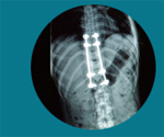 Cheap and Affordable Spine Surgery in India, Best Hospitals for Spine Surgery in India, Best Doctors for Spine Surgery in India , Medkaizen Global, Apollo Hospitals, Fortis Hospitals, Max Hospitals, Artemis Hospitals, Medanta Hospitals, Manipal Hospitals, Hospitals for Medical Tourism in India, Hospital for Medical Treatment in India, Hospitals for Surgery in India, Medical Tourism in India, Medical Treatment in India, Surgery in India, Medical Tourism Company