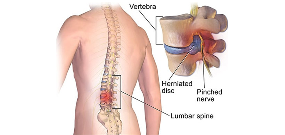 Cheap and Affordable Spine Surgery in India, Best Hospitals for Spine Surgery in India, Best Doctors for Spine Surgery in India , Medkaizen Global, Apollo Hospitals, Fortis Hospitals, Max Hospitals, Artemis Hospitals, Medanta Hospitals, Manipal Hospitals, Hospitals for Medical Tourism in India, Hospital for Medical Treatment in India, Hospitals for Surgery in India, Medical Tourism in India, Medical Treatment in India, Surgery in India, Medical Tourism Company