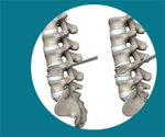 Cheap and Affordable Spine Surgery in India, Best Hospitals for Spine Surgery in India, Best Doctors for Spine Surgery in India , Medkaizen Global, Apollo Hospitals, Fortis Hospitals, Max Hospitals, Artemis Hospitals, Medanta Hospitals, Manipal Hospitals, Hospitals for Medical Tourism in India, Hospital for Medical Treatment in India, Hospitals for Surgery in India, Medical Tourism in India, Medical Treatment in India, Surgery in India, Medical Tourism Company
