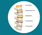Cheap and Affordable Spine Surgery in India, Best Hospitals for Spine Surgery in India, Best Doctors for Spine Surgery in India , Medkaizen Global, Apollo Hospitals, Fortis Hospitals, Max Hospitals, Artemis Hospitals, Medanta Hospitals, Manipal Hospitals, Hospitals for Medical Tourism in India, Hospital for Medical Treatment in India, Hospitals for Surgery in India, Medical Tourism in India, Medical Treatment in India, Surgery in India, Medical Tourism Company
